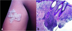 A. Tuberculose cutânea verrucosa: placa verrucosa de expansão centrífuga no braço esquerdo. B. Tuberculose cutânea verrucosa: epiderme com hiperplasia focal e derme mostra infiltrado inflamatório granulomatoso que envolve estruturas foliculares e vasos. (Hematoxilina & eosina, 40×).