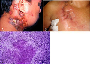 A. Escrofuloderma – nódulos/gomas e ulcerações nas regiões cervical e mastoidea direita associadas a tuberculose de linfonodos. B. Escrofuloderma – lesões infiltradas e ulceradas na região clavicular direita. C. Escrofuloderma – necrose caseosa circundada por infiltrado granulomatoso em paliçada de macrófagos e células gigantes multinucleadas do tipo Langhans. (Hematoxilina & eosina, 40×).