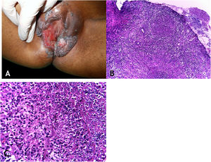 A. Tuberculose cutânea orificial – lesão úlcerovegetante que compromete grandes e pequenos lábios. B. Tuberculose cutânea orificial – epiderme ulcerada e massivo infiltrado inflamatório granulomatoso dérmico. (Hematoxilina & eosina, 40×). C. Tuberculose cutânea orificial – granuloma associado a necrose caseosa. (Hematoxilina & eosina, 200×). Fotos: Dra. Maraya Bittencourt.