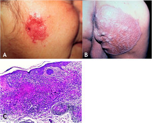 A. Lúpus vulgar – lesão infiltrada, erodida, de bordas nítidas, na região masseterina direita. B. Lúpus vulgar – extensa placa semeada de pápulas/nódulos, áreas cicatriciais, com bordas nítidas e levadas na região glútea direita. C. Lúpus vulgar – derme mostra infiltrado inflamatório granulomatoso associado a focos de necrose caseosa (Hematoxilina & eosina, 40×).