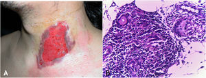 A. Tuberculose cutânea gomosa – úlcera irregular de bordas nítidas na região cervical. B. Tuberculose cutânea gomosa – granuloma composto por linfócitos, macrófagos e células gigantes multinucleadas (Hematoxilina & eosina, 200×).
