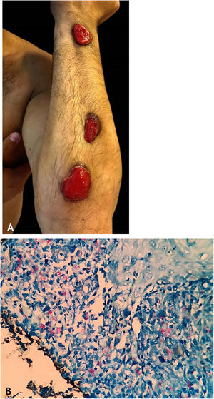A. Tuberculose cutânea gomosa esporotricoide – lesões ulceradas ao longo do membro superior. B. Tuberculose cutânea gomosa esporotricoide – numerosos BAAR no infiltrado à coloração pelo Fite‐Faraco. Fotos: Dra. Deborah Unger.