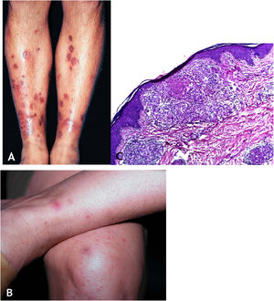 A. Tubercúlide papulonecrótica – lesões “em saca‐bocado” nos membros inferiores. B. Tubercúlide papulonecrótica – lesões papuloeritematosas e papulocrostosas nos membros inferiores. C. Tubercúlide papulonecrótica – atrofia da epiderme e derme subjacente com granulomas com necrose caseosa (Hematoxilina & eosina, 40×).