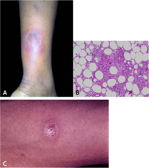 A. Eritema indurado de Bazin – nódulo infiltrado eritematovioláceo na face posterior da perna. B. Eritema indurado de Bazin – paniculite granulomatosa lobular (Hematoxilina & eosina, 40×). C. Eritema indurado de Bazin: derivado proteico purificado reator forte.