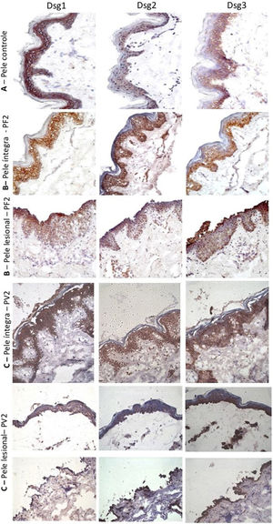 Painel de imuno‐histoquímica com expressões de Dsg1, Dsg2 e Dsg3 em amostras de pele (amplificação original de 40×). A, Amostra de pele controle de abdominoplastia mostrando a distribuição típica de Dsg1, Dsg2 e Dsg3 na epiderme. B, PF‐pele íntegra mostrando expressões aumentadas da Dsg2 e Dsg3 em toda a epiderme e PF‐pele lesional mostrando expressões aumentadas da Dsg2 e Dsg3 no teto e no assoalho da bolha acantolítica. C, PV‐pele íntegra mostrando expressões aumentadas da Dsg2 e de Dsg3 em toda a epiderme e PV‐pele lesional mostrando expressões aumentadas da Dsg2 e Dsg3 no teto e no assoalho da bolha e nas células acantolíticas.