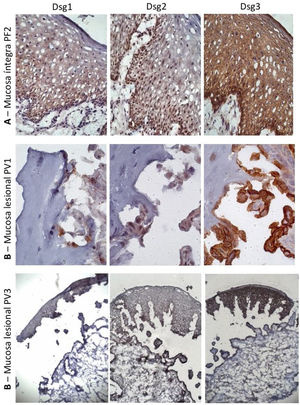 Painel de imuno‐histoquímica com expressões de Dsg1, Dsg2 e Dsg3 em amostras de mucosa. A, PF‐mucosa íntegra mostrando a distribuição típica de Dsg1, Dsg2 e Dsg3 na epiderme (amplificação original de 63×). B, PV‐mucosa lesional mostrando expressão da Dsg2 e Dsg3 circundando a bolha acantolítica (amplificação original de 100× e 40×).