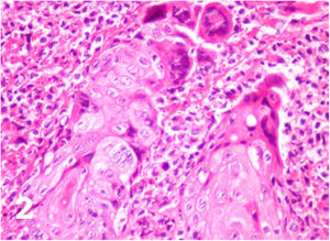 Efeitos citopáticos do herpes simples, como degeneração balonizante dos ceratinócitos, cromatina marginalizada, células gigantes multinucleadas (Hematoxilina & eosina, 400×).