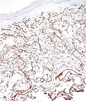 Imuno‐histoquímica realçando proliferação do endotélio vascular com o CD34.