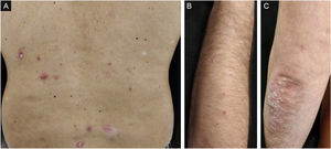 Psoríase gutata e exacerbação de psoríase crônica em placas (caso 1). (A), Placas eritematosas semelhantes a gotas de psoríase gutata e placas eritematosas escamosas no tronco. (B), Placas eritematosas semelhantes a gotas de psoríase gutata nos membros superiores. (C), Placas eritematosas escamosas nos cotovelos.