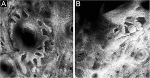 (A), Hiperplasia formando protrusões irregulares digitiformes ao redor do folículo piloso. (B), Hiperplasia papilomatosa no epitélio do folículo piloso na microscopia confocal de reflectância.