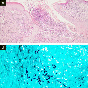 (A), A histopatologia da amostra cirúrgica da primeira paciente mostra edema difuso e células inflamatórias mistas com formação de micro‐abscessos, hifas hialinas em células gigantes multinucleadas com neutrófilos circundantes (Hematoxilina & eosina, 100×). (B), Coloração pela prata metenamina de Grocott revelando múltiplas hifas septadas ramificadas (400×).
