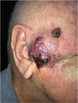 Carcinoma sebáceo extraocular. Tumoração de 5cm, bocelada, eritemato‐vinhosa, de localização pré‐auricular direita, com áreas friáveis e necróticas. Lesão satélite de 1cm com características semelhantes e cicatriz de exérese de carcinoma espinocelular.