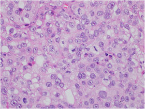 Carcinoma sebáceo extraocular. Detalhe das células neoplásicas exibindo pleomorfismo nuclear, nucléolos proeminentes e citoplasma multilobado (Hematoxilina & eosina, 400×).