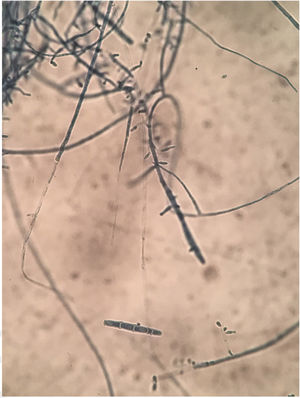 Exame microscópico mostrando esporos macroconídeos e microconídeos semelhantes a clavas.