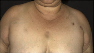 Nódulos hipercrômicos na região torácica superior e no membro superior esquerdo.