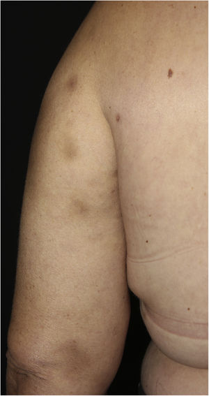 Nódulos hipercrômicos no membro superior esquerdo.