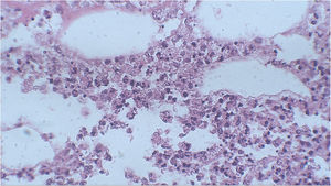 Em maior aumento, observamos no exame histopatológico a presença de infiltrado neutrofílico hipodérmico (Hematoxilina & eosina, 400×).