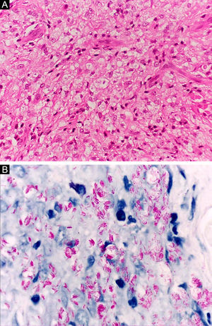 Hanseníase virchowiana. (A), Denso infiltrado celular dérmico composto por macrófagos de citoplasma vacuolizado. (Hematoxilina & eosina, 400×) (B), Numerosos bacilos álcool‐ácido resistentes isolados e em formação de globias. (Faraco, 1000×).
