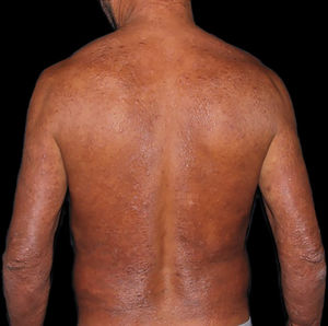 Hanseníase virchowiana. Enduração eritemato‐ferruginosa difusa, entremeada por máculas e pápulas poupando a região da coluna e axila e predominando nos cotovelos.