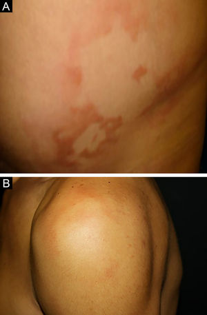 (A), Hanseníase dimorfa. Placas e pápulas eritemato‐edematosas bem delimitadas. (B), Hanseníase dimorfa‐virchowiana. Placas eritematosas, centro hipocrômico bem‐delimitado e bordas externas imprecisas.