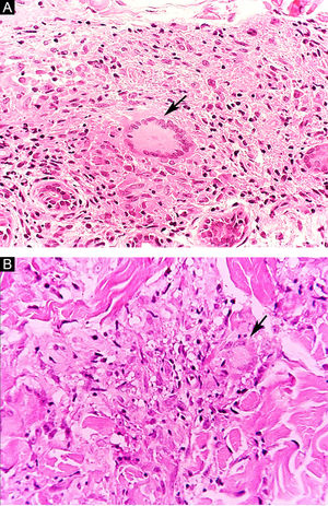 (A), Hanseníase tuberculoide. Granuloma epitelioide com célula gigante multinucleada de tipo Langhans (seta). (B), Hanseníase dimorfa. Arranjo granulomatoso frouxo com presença de célula gigante multinucleada com fina vacuolização citoplasmática (seta). (Hematoxilina & eosina, 400×).