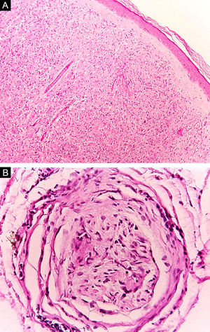 Hanseníase virchowiana. (A), Epiderme retificada e separada do denso infiltrado dérmico por faixa colágena. (Hematoxilina & eosina, 40×) (B), Corte transversal de nervo dérmico com delaminação do perineuro. (Hematoxilina & eosina, 200×).