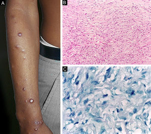 Hanseníase históide. (A), Pápulas eritemato‐ferruginosas bem‐delimitadas dispersas pelo membro. (B), Proliferação de macrófagos fusiformes com citoplasma finamente vacuolizado. (Hematoxilina & eosina, 200×) (C), Bacilos álcool‐ácido resistentes no citoplasma de macrófagos fusiformes. (Faraco, 1000×).