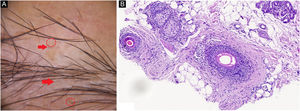 (A), Pelo velo (seta vermelha), pontos amarelos (círculo vermelho). (B), Infiltrado linfocítico com fibrose peribulbar (Hematoxilina & eosina 100×).