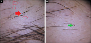 (A), Folículos vazios (círculos vermelhos), pelos fraturados (seta vermelha). (B), Pelo em ponto de interrogação (seta verde).