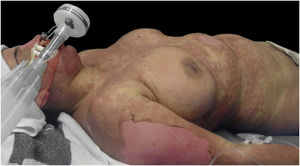 Bolhas, vesículas e descolamento da epiderme.