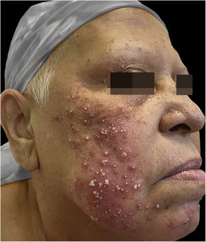 Presença de pústulas sobre base eritematosa, simetricamente distribuídas na face.