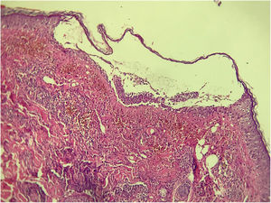 Exame histopatológico corado por Hematoxilina & eosina, com presença de pústula subcórnea intraepidérmica com infiltrado linfocitário perivascular superficial, (Hematoxilina & eosina, 10×).
