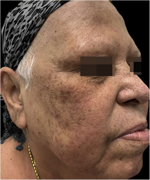Hipercromia pós‐inflamatória sem presença de lesões pustulosas.