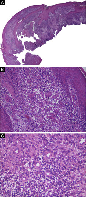 Análise histopatológica da biópsia de pele. (A), Hiperplasia pseudoepiteliomatosa (Hematoxilina & eosina, 20x). (B), Células gigantes multinucleadas (Hematoxilina & eosina, 200x). (C), Plasmócitos (Hematoxilina & eosina, 400x).