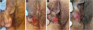 Paciente com herpes mucocutâneo crônico hipertrófico tumoral. (A), Pré‐tratamento. (B), No pós‐operatório imediato da remoção cirúrgica da lesão tumoral. (C), Após quatro semanas da exérese cirúrgica, com ferida operatória em cicatrização. (D), Após 10 semanas do procedimento, com lesão cicatrizada.