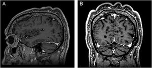 Ressonância magnética do crânio. (A), Corte sagital. (B), Corte coronal, demonstrando ondulações na pele.