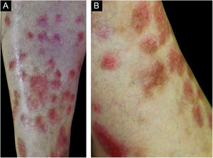 (A e B), Nódulos eritematosos na face extensora das pernas.