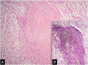 (A), Infiltrado na parede de vaso de médio calibre com lúmen ocluído por trombo fibrinoide (Hematoxilina & eosina, 200×). (B), Presença da lâmina elástica interna (coloração de Verhoeff‐van Gieson).
