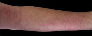 Eczema no membro superior por dermatite alérgica de contato a corticosteroide.
