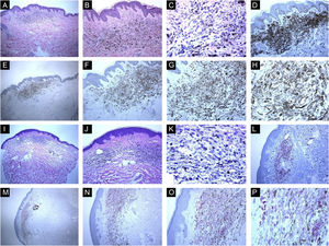Características imuno‐histológicas de nevos azuis comuns com expressão da proteína HMB45 (padrões de coloração difusos ou irregulares). (A, B e C), Caso de uma paciente de 59 anos que apresentou mácula brilhante hiperpigmentada de 0,5cm na pele do braço direito. Histopatologicamente, a lesão é composta por uma proliferação de melanócitos dendríticos e fusiformes, misturados com macrófagos carregados de pigmento (“melanófagos”). Figuras mitóticas e atividade melanocítica juncional estão ausentes. A maturação histológica é observada nas partes periférica e profunda da lesão, onde as células fusiformes se insinuam isoladamente entre as fibras colágenas espessadas da derme reticular. Infiltrado linfocítico perivascular esparso também é visto. Não há necrose celular individual ou células em mitose. (D), A avaliação imuno‐histoquímica adicional foi realizada com os controles positivos e negativos adequados que revelaram forte imunomarcação difusa para Melan‐A. (E, F, G e H), As células tumorais apresentam expressão da proteína HMB45 em toda a lesão (padrão difuso de coloração). (I, J, K e L), Caso de uma paciente de 63 anos com mácula hiperpigmentada de 0,4cm na parede torácica. Os cortes histológicos mostram uma mistura de melanócitos epitelioides dendríticos e melanófagos na derme reticular média em meio a feixes de colágeno. (L), Não há mitoses ou necrose celular individual ou infiltrado de células inflamatórias: Avaliação imuno‐histoquímica adicional foi realizada com os controles positivos e negativos adequados que revelaram forte coloração difusa para Melan‐A. (M, N, O e P), As células tumorais apresentam expressão difusa da proteína HMB45 em toda a lesão.