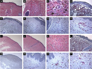 Características imunohistológicas de nevos azuis comuns com expressão da proteína HMB45 (padrões de coloração celular irregulares ou individuais). (A, B e C), Caso de uma paciente de 56 anos com mácula hiperpigmentada, de 0,2cm, no meio da região dorsal superior. Histopatologicamente, há um crescimento dérmico bem circunscrito e simétrico composto por melanócitos alongados e finamente ramificados insinuados entre as fibras de colágeno da derme superior e média. Os melanócitos estão misturados com alguns melanófagos. Há agregação perianexial (perifolicular) dos melanócitos. (D), Avaliação imuno‐histoquímica adicional foi realizada com os controles positivos e negativos adequados que revelaram forte coloração difusa para Melan‐A em toda a lesão. (E, F, G e H), Alguns grupos de melanócitos dérmicos positivos para HMB45 são observados (padrão irregular de coloração). (I, J, K e L), Caso de uma paciente de 49 anos com lesão lisa, marrom‐acinzentada, medindo 0,7cm, na pele da região glútea esquerda. Cortes histológicos mostram alteração da derme por um crescimento simétrico que consiste em uma mistura variável de melanócitos dendríticos, alguns melanófagos e fibrose. Não há atipia citológica aparente, necrose celular ou atividade mitótica. Avaliação imuno‐histoquímica adicional foi realizada com os controles positivos e negativos adequados que revelaram forte coloração difusa para Melan‐A em toda a lesão. (M, N, O e P), Observam‐se ocasionalmente células névicas dérmicas positivas para HMB45 (padrão de coloração de células individuais).