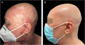(A), Paciente com DA grave, alopecia areata e infecção por molusco contagioso antes do tratamento com dupilumabe. Escoriações, lesões eczematosas e pápulas cupuliformes com umbilicação central espalhadas por todo o corpo, mas principalmente na face e no couro cabeludo. (B), Dois meses após o início do tratamento com dupilumabe. Remissão clínica da dermatite atópica e resolução da infecção por molusco contagioso.