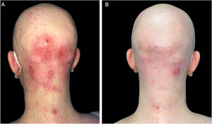 (A), Paciente com DA grave, alopecia areata e infecção por molusco contagioso antes do tratamento com dupilumabe. Escoriações, lesões eczematosas e pápulas cupuliformes com umbilicação central espalhadas por todo o corpo, mas principalmente na face e couro cabeludo. (B), Dois meses após o início do tratamento com dupilumabe. Remissão clínica da dermatite atópica e resolução da infecção por molusco contagioso.