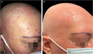 (A), Paciente com DA grave, alopecia areata e infecção por molusco contagioso antes do tratamento com dupilumabe. Escoriações, lesões eczematosas e pápulas cupuliformes com umbilicação central espalhadas por todo o corpo, mas principalmente na face e couro cabeludo. (B), Dois meses após o início do tratamento com dupilumabe. Remissão clínica da dermatite atópica e resolução da infecção por molusco contagioso.