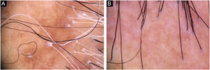 Tricoscopia com achados comuns a pacientes com LPP e AFF. (A), Descamação peripilar e ausência de aberturas foliculares em paciente com LPP. (B), Descamação peripilar discreta e eritema peripilar leve em paciente com AFF.