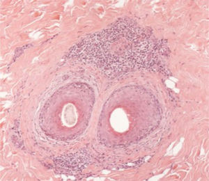 Histopatológico: Corte transversal (Hematoxilina & eosina, 100×). Presença de infiltrado inflamatório linfocítico moderado perifolicular em região de istmo.