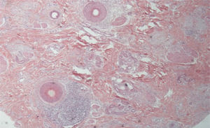Corte transversal (Hematoxilina & eosina, 100×). Presença de infiltrado inflamatório linfocítico perifolicular em região de istmo com fibrose eosinofílica concêntrica.
