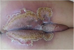 Aspecto clínico inicial, com erosão perianal e interglútea com bordas pustulosas circinadas e algumas pústulas isoladas.