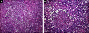Infiltrado inflamatório com neutrófilos e corpúsculos basofílicos granulares (grânulos). (A), Hematoxilina & eosina 100×. (B), Hematoxilina & eosina, 400×.