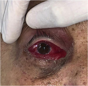 Eritema e edema intenso na conjuntiva, associado a eritema na pálpebra superior. Mucormicose rino‐órbito‐cerebral.